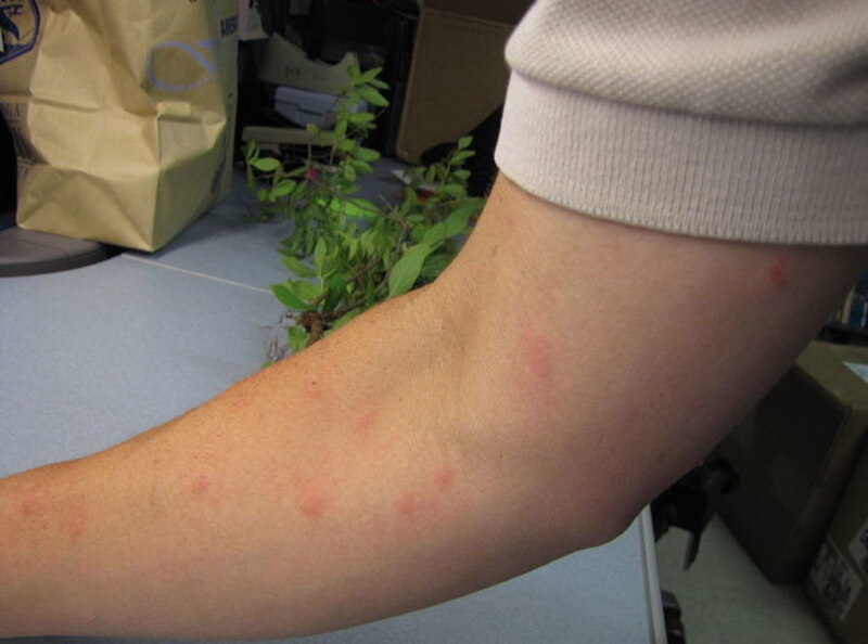 mosquito bite on arm